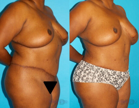 Brazilian Butt Lift case #4513