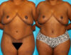 Brazilian Butt Lift case #4513 slider thumbnail