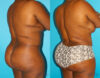 Brazilian Butt Lift case #4513 slider thumbnail
