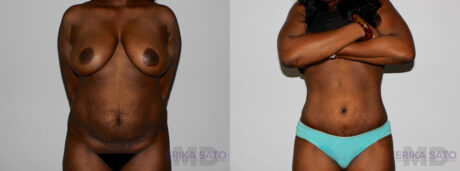 Brazilian Butt Lift case #4471