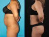 Brazilian Butt Lift case #4537 slider thumbnail