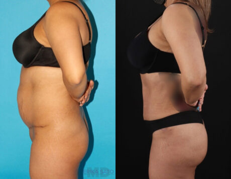 Brazilian Butt Lift case #4537