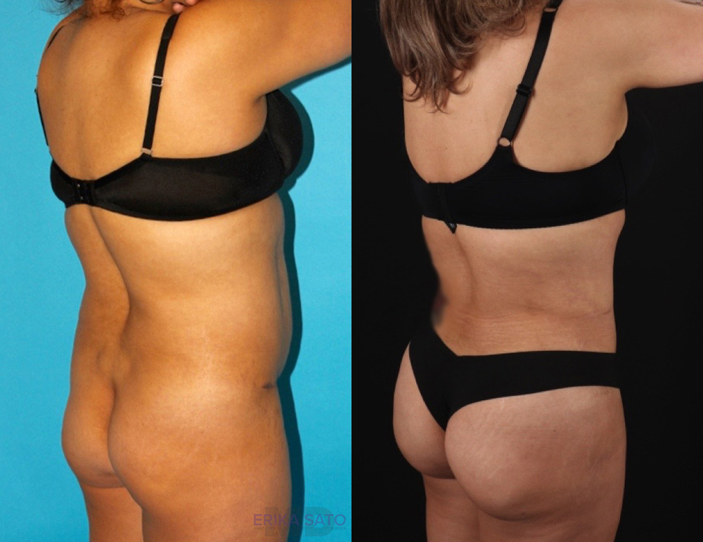 Brazilian Butt Lift case #4537