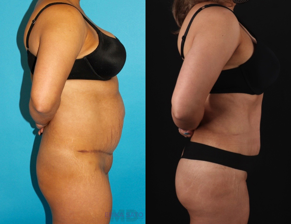 Brazilian Butt Lift case #4537