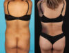 Brazilian Butt Lift case #4537 slider thumbnail