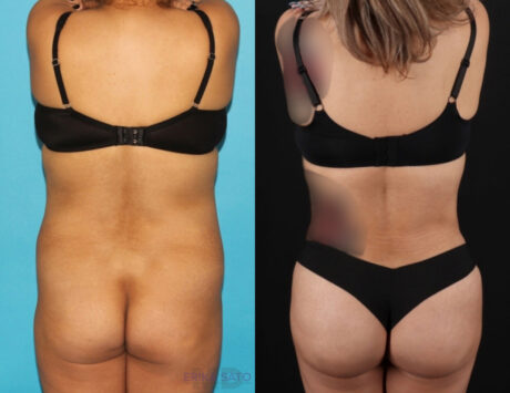 Brazilian Butt Lift case #4537