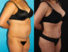 Brazilian Butt Lift case #4537 slider thumbnail