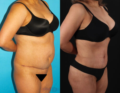 Brazilian Butt Lift case #4537