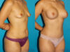 Post Bariatric Surgery (Massive Weight Loss) case #6777 slider thumbnail