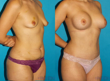 Post Bariatric Surgery (Massive Weight Loss) case #6777