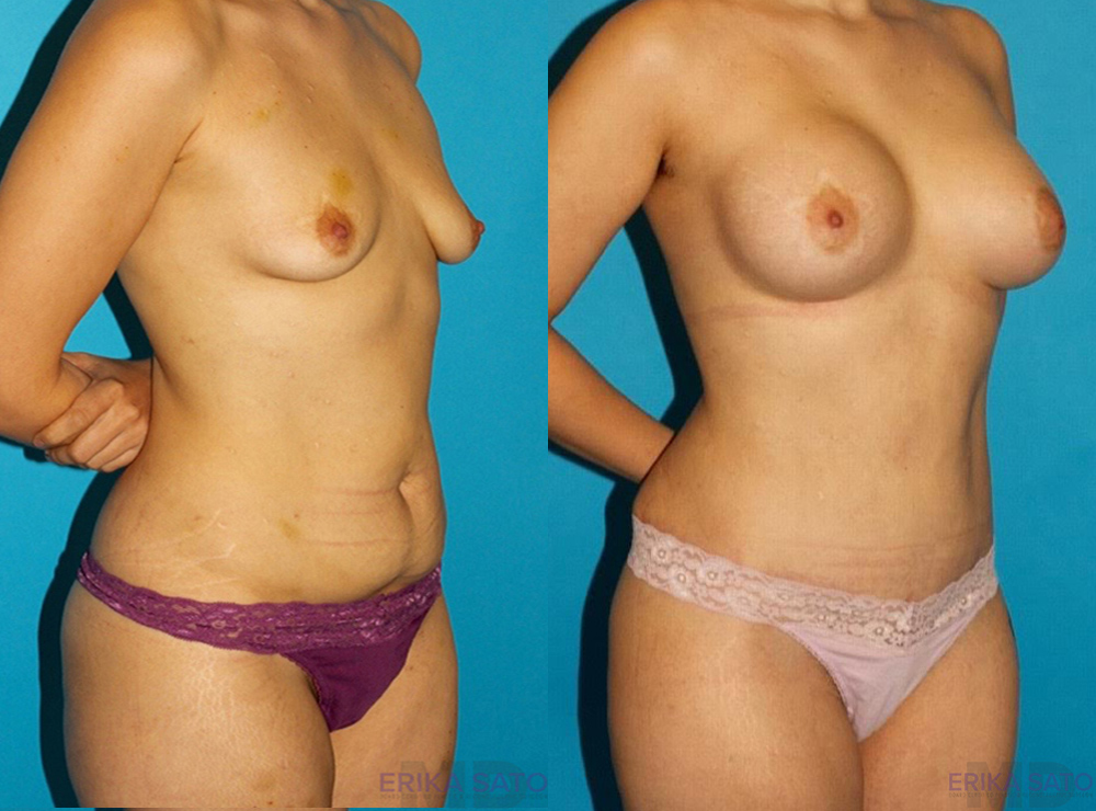 Post Bariatric Surgery (Massive Weight Loss) case #6777
