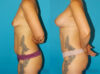 Post Bariatric Surgery (Massive Weight Loss) case #6777 slider thumbnail