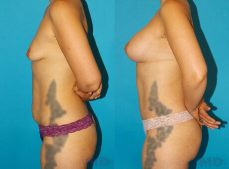 Post Bariatric Surgery (Massive Weight Loss) case #6777
