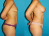 Post Bariatric Surgery (Massive Weight Loss) case #6777 slider thumbnail