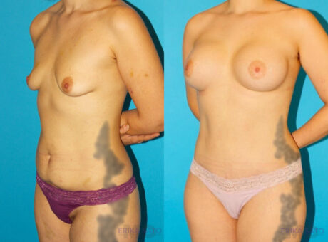 Post Bariatric Surgery (Massive Weight Loss) case #6777