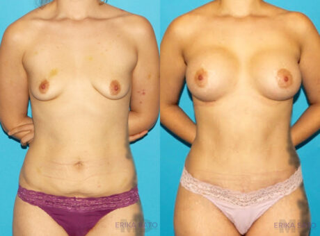 Post Bariatric Surgery (Massive Weight Loss) case #6777