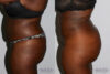 Brazilian Butt Lift case #4625 slider thumbnail