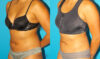 Liposuction case #5890 slider thumbnail