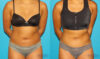 Liposuction case #5890 slider thumbnail