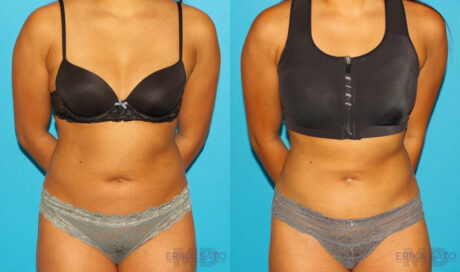 Liposuction case #5890
