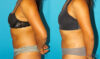 Liposuction case #5890 slider thumbnail