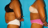 Tummy Tuck case #7283 slider thumbnail