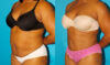 Tummy Tuck case #7283 slider thumbnail