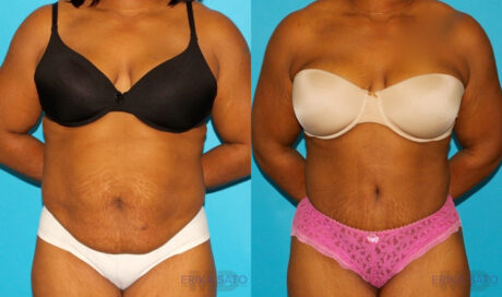 Tummy Tuck case #7283
