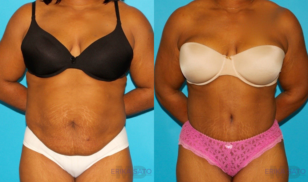 Tummy Tuck case #7283