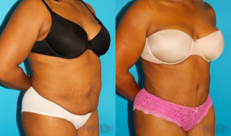 Tummy Tuck case #7283
