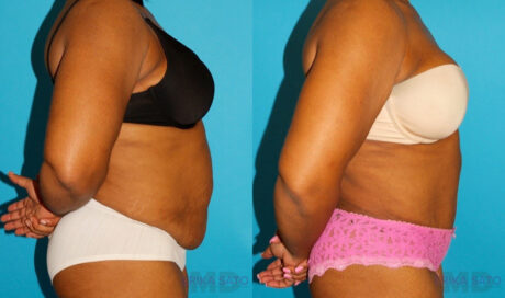 Tummy Tuck case #7283