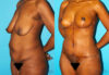 Post Bariatric Surgery (Massive Weight Loss) case #6776 slider thumbnail