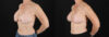 Revision Breast Surgery case #256267 slider thumbnail