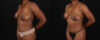 Mommy Makeover case #6688 slider thumbnail