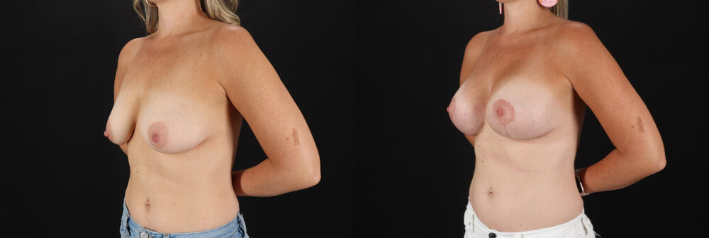 Breast Lift with Implants case #7903