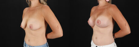 Breast Lift with Implants case #7903