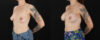 Breast Augmentation case #6491 slider thumbnail