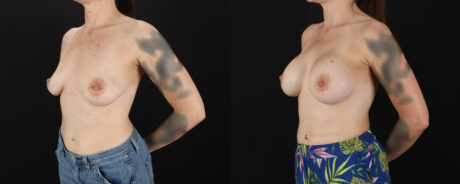 Breast Augmentation case #6491