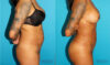 Brazilian Butt Lift case #4764 slider thumbnail