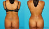 Brazilian Butt Lift case #4764 slider thumbnail