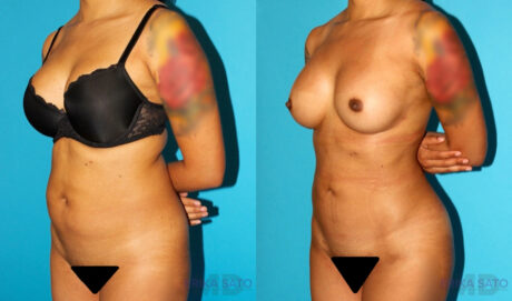 Brazilian Butt Lift case #4764