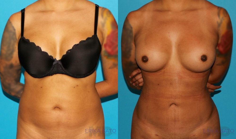 Brazilian Butt Lift case #4764