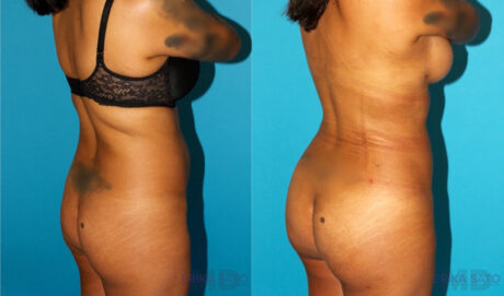 Brazilian Butt Lift case #4764