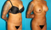 Brazilian Butt Lift case #4764 slider thumbnail