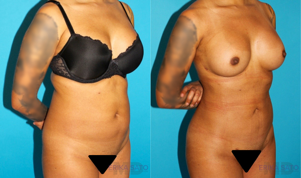 Brazilian Butt Lift case #4764