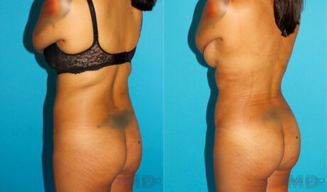 Brazilian Butt Lift case #4764