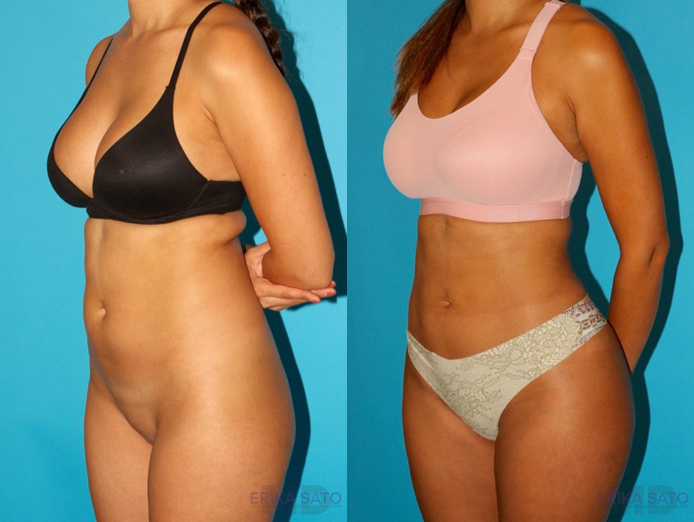 Brazilian Butt Lift case #4765