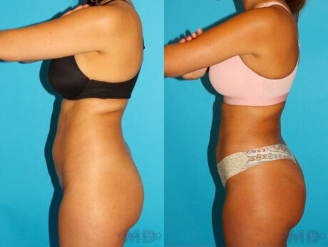 Brazilian Butt Lift case #4765