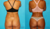 Brazilian Butt Lift case #4765 slider thumbnail