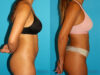 Brazilian Butt Lift case #4765 slider thumbnail